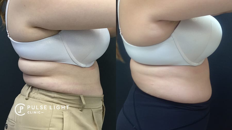 How CoolSculpting® Works for Stubborn Bra Bulge