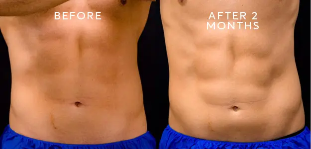 Can You Get A Six Pack With EMSculpt?