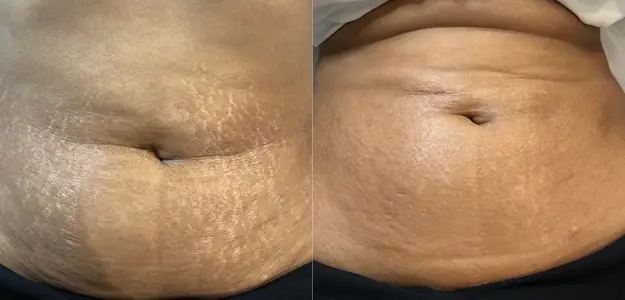 Stretch Marks - Why Do Some Women Get Them and Others Don't?