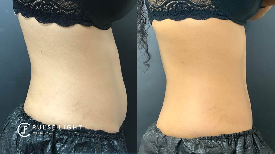 CoolSculpting  Know your applicators before getting treated