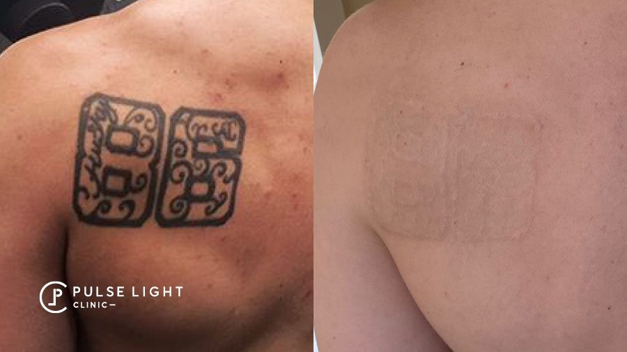Can Laser Tattoo Removal Cause Blistering  MEDermis Laser Clinic