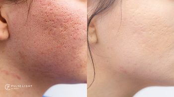 Speed Up CO2 Laser Resurfacing Healing | Pulse Light Clinic