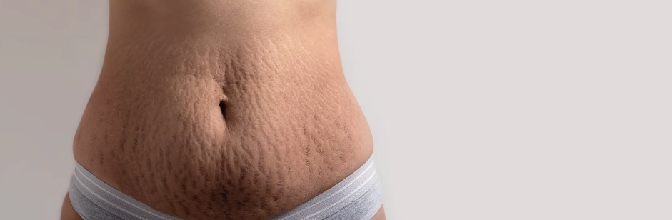 Stretch Marks After Pregnancy: 9 Tips for Removing Them