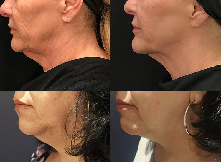 Skin Tightening Treatments To Target Loose Skin After Weight Loss