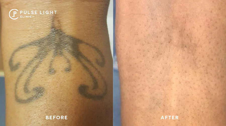 Tattoo Laser Removal Near Me